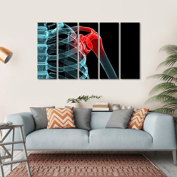 X-Ray Of Painful Shoulder Canvas Wall Art-5 Horizontal-Gallery Wrap-22" x 12"-Tiaracle