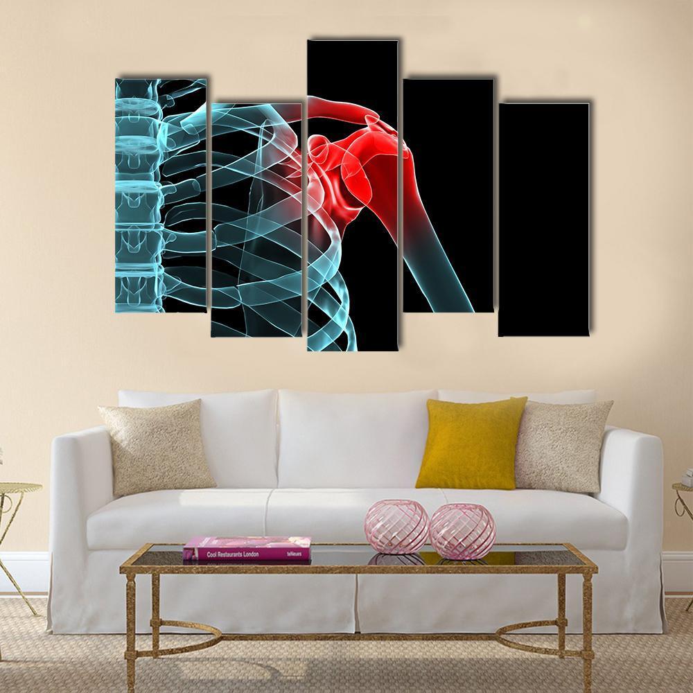 X-Ray Of Painful Shoulder Canvas Wall Art-5 Pop-Gallery Wrap-47" x 32"-Tiaracle