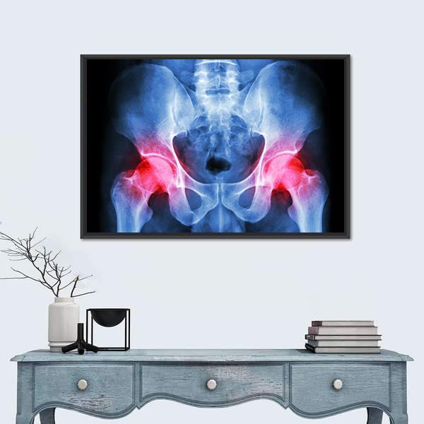 X-Ray Of Pelvis Canvas Wall Art-1 Piece-Floating Frame-24&quot; x 16&quot;-Tiaracle