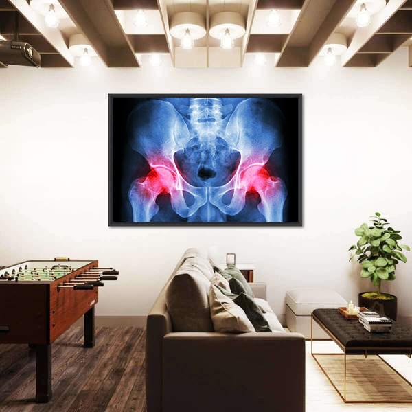 X-Ray Of Pelvis Canvas Wall Art-5 Horizontal-Gallery Wrap-22&quot; x 12&quot;-Tiaracle