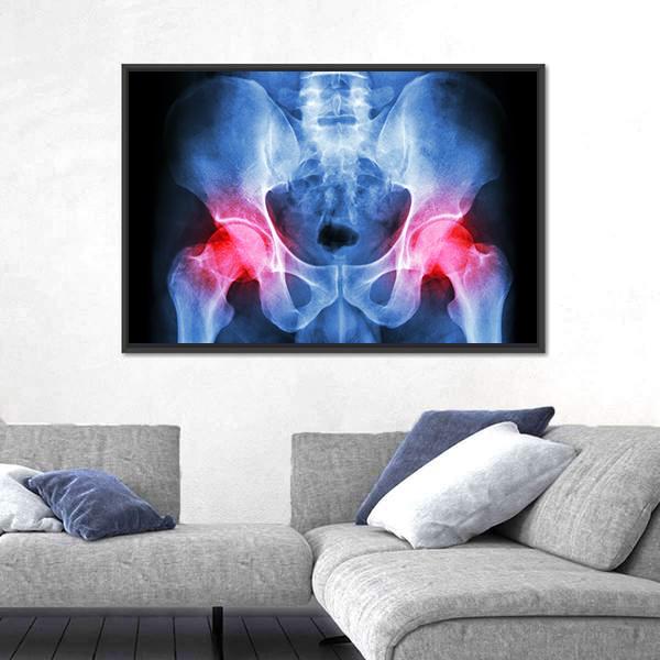 X-Ray Of Pelvis Canvas Wall Art-5 Horizontal-Gallery Wrap-22&quot; x 12&quot;-Tiaracle