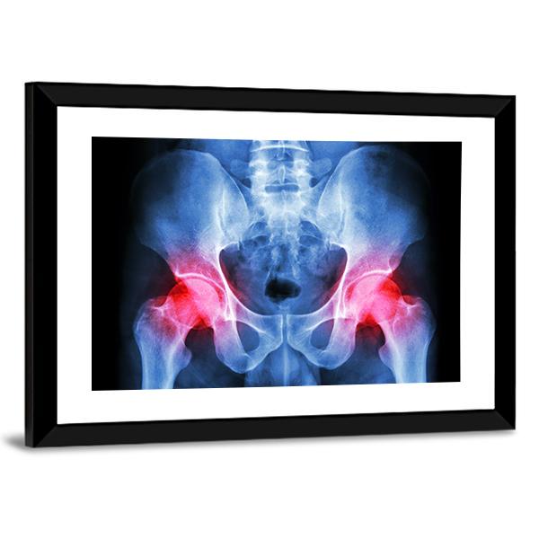 X-Ray Of Pelvis Canvas Wall Art-5 Horizontal-Gallery Wrap-22" x 12"-Tiaracle