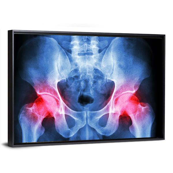 X-Ray Of Pelvis Canvas Wall Art-5 Horizontal-Gallery Wrap-22" x 12"-Tiaracle