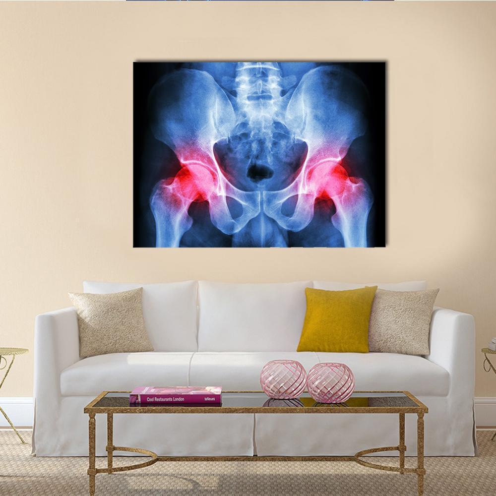 Pelvis X-ray Canvas Wall Art in black, red and blue, single panel hung on a wall