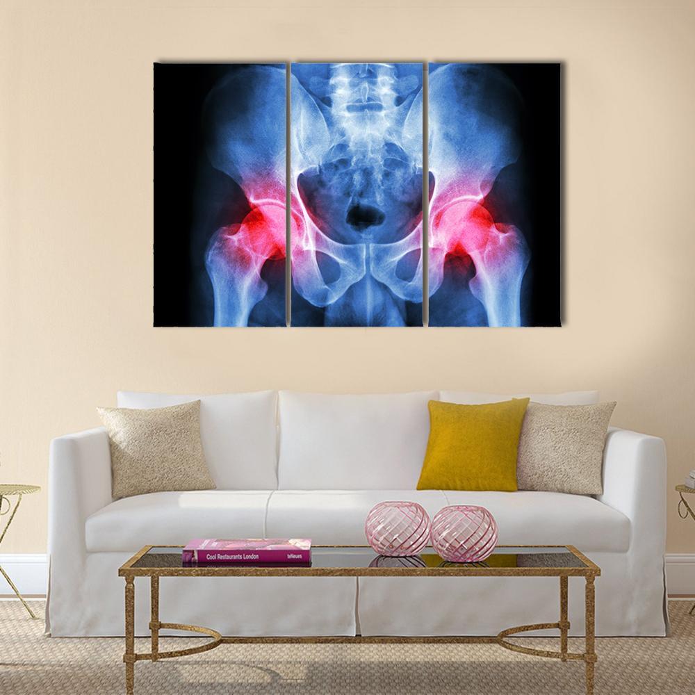 X-Ray Of Pelvis Canvas Wall Art-3 Horizontal-Gallery Wrap-37&quot; x 24&quot;-Tiaracle