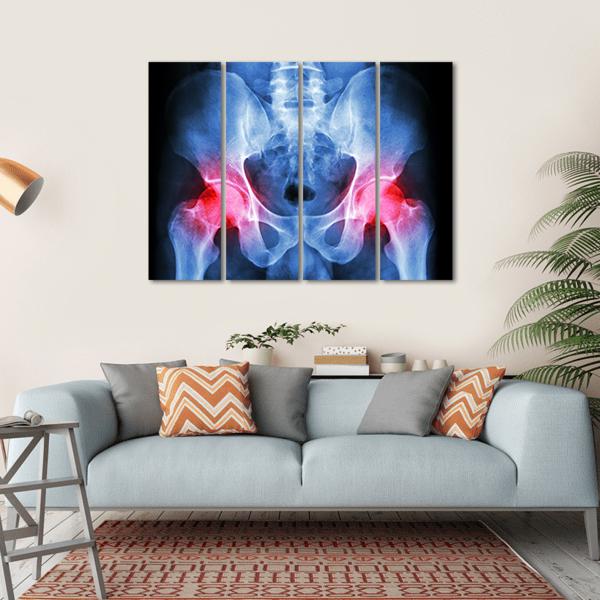 X-Ray Of Pelvis Canvas Wall Art-4 Horizontal-Gallery Wrap-34&quot; x 24&quot;-Tiaracle