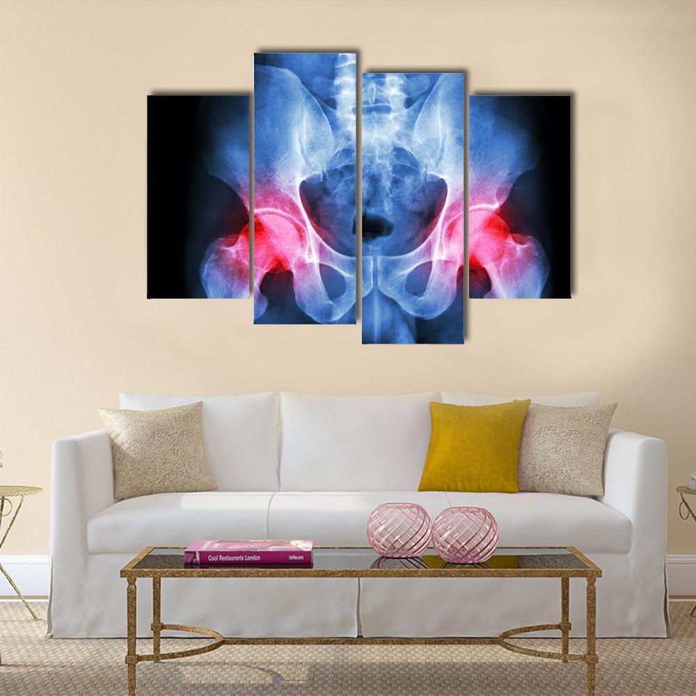 X-Ray Of Pelvis Canvas Wall Art-4 Pop-Gallery Wrap-50&quot; x 32&quot;-Tiaracle