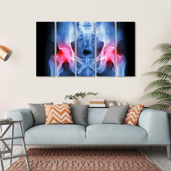 X-Ray Of Pelvis Canvas Wall Art-5 Horizontal-Gallery Wrap-22&quot; x 12&quot;-Tiaracle