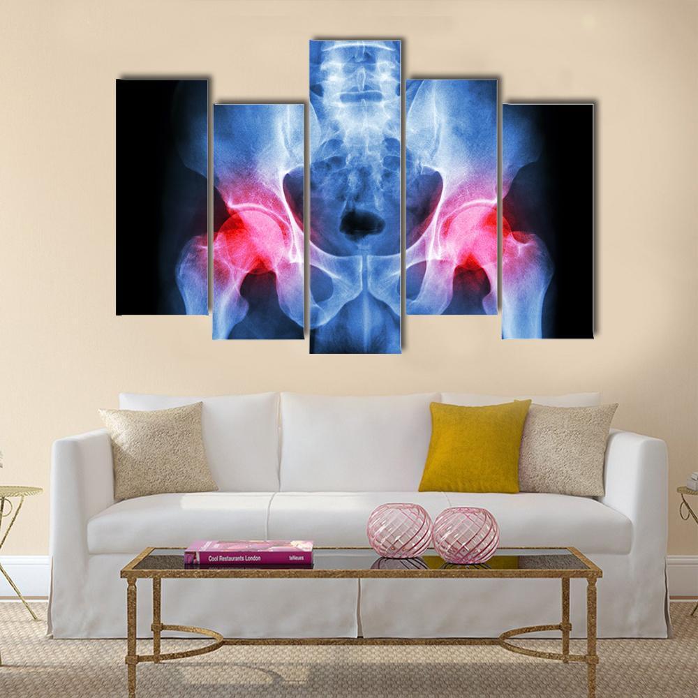 X-Ray Of Pelvis Canvas Wall Art-3 Horizontal-Gallery Wrap-25" x 16"-Tiaracle