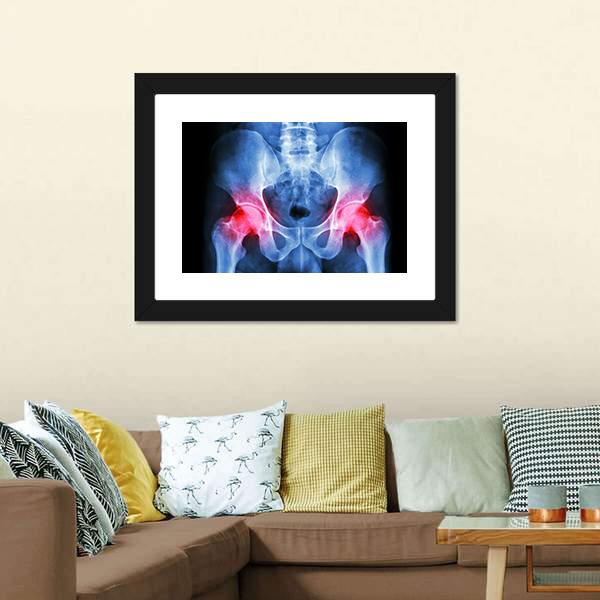 X-Ray Of Pelvis Canvas Wall Art-3 Horizontal-Gallery Wrap-25&quot; x 16&quot;-Tiaracle