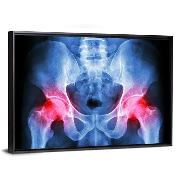 X-Ray Of Pelvis Canvas Wall Art-3 Horizontal-Gallery Wrap-25" x 16"-Tiaracle