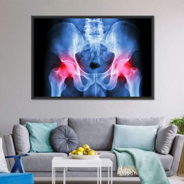 X-Ray Of Pelvis Canvas Wall Art-3 Horizontal-Gallery Wrap-25&quot; x 16&quot;-Tiaracle