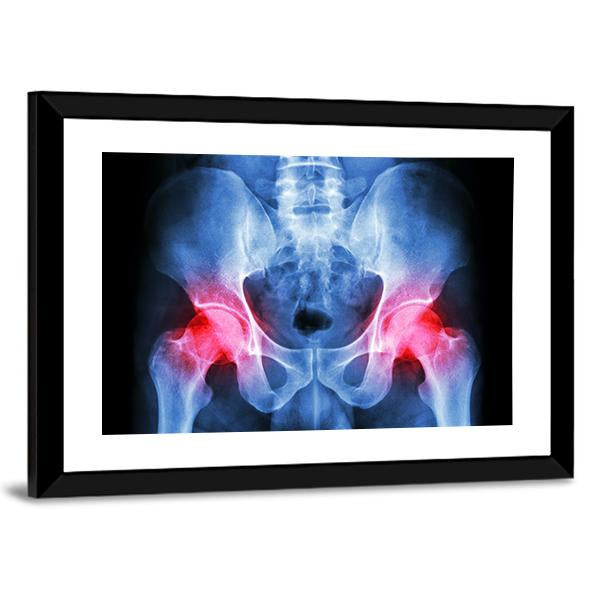 X-Ray Of Pelvis Canvas Wall Art-3 Horizontal-Gallery Wrap-25&quot; x 16&quot;-Tiaracle