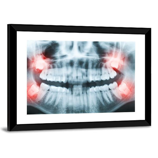 X-Ray Of Teeth And Mouth Canvas Wall Art-3 Horizontal-Gallery Wrap-25" x 16"-Tiaracle