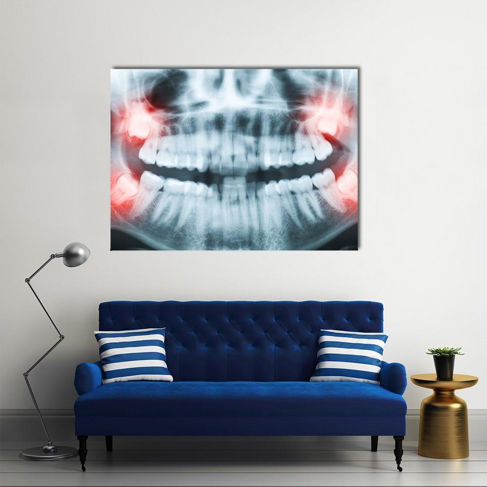 Dental X-ray of Jaw and Wisdom Teeth Canvas Wall Art in black, white and red, single panel hung on a wall