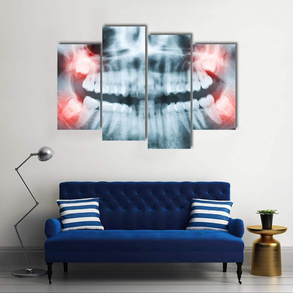 X-Ray Of Teeth And Mouth Canvas Wall Art-4 Pop-Gallery Wrap-50" x 32"-Tiaracle