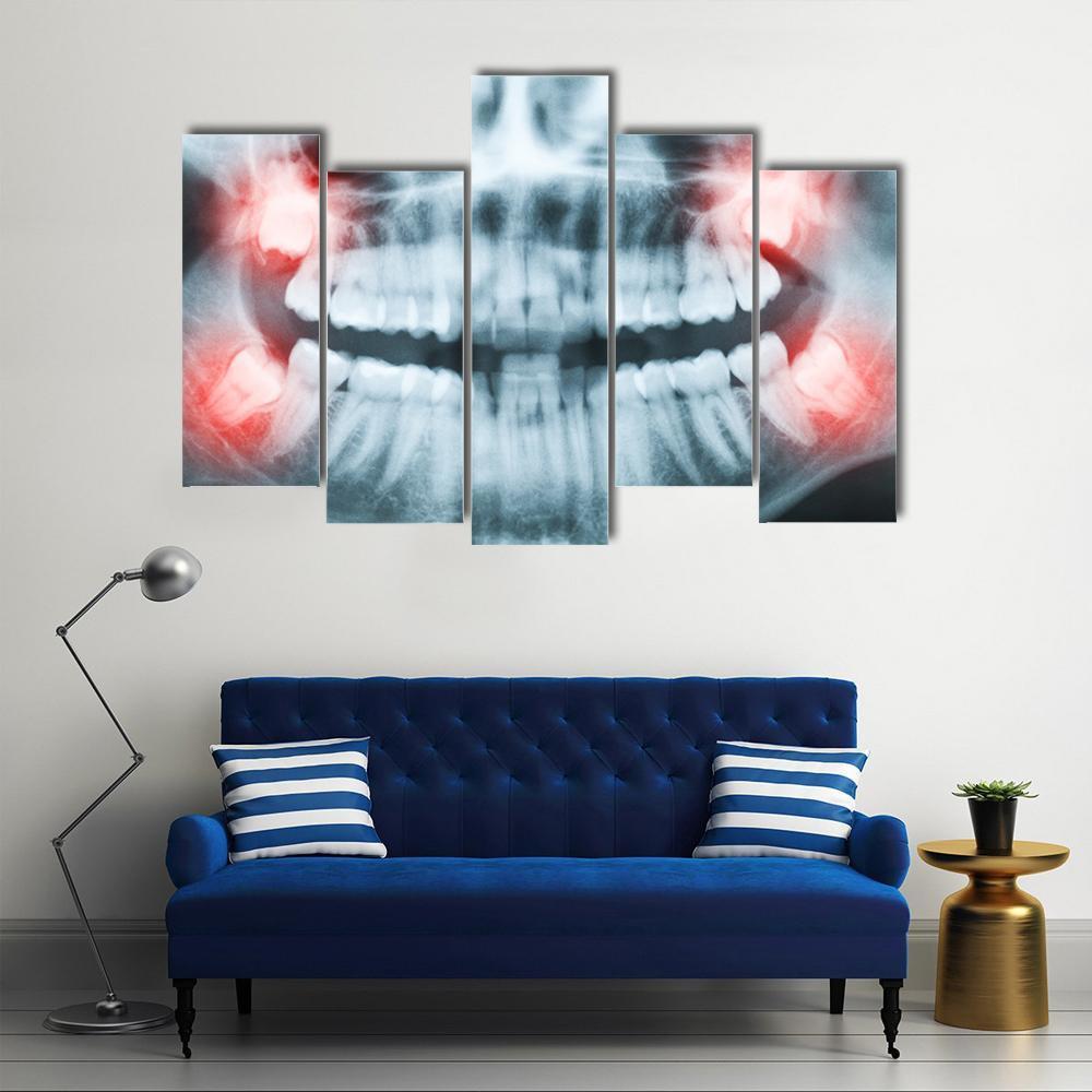 X-Ray Of Teeth And Mouth Canvas Wall Art-5 Pop-Gallery Wrap-47" x 32"-Tiaracle