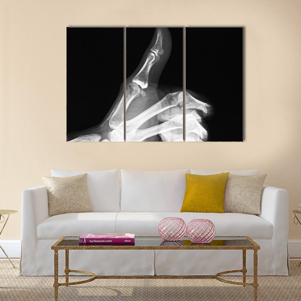X-Ray Of Thumb Up Canvas Wall Art-3 Horizontal-Gallery Wrap-37" x 24"-Tiaracle