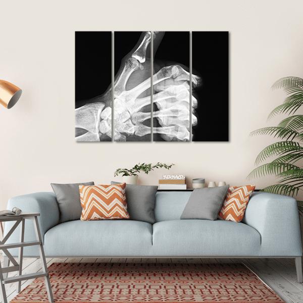 X-Ray Of Thumb Up Canvas Wall Art-4 Horizontal-Gallery Wrap-34" x 24"-Tiaracle
