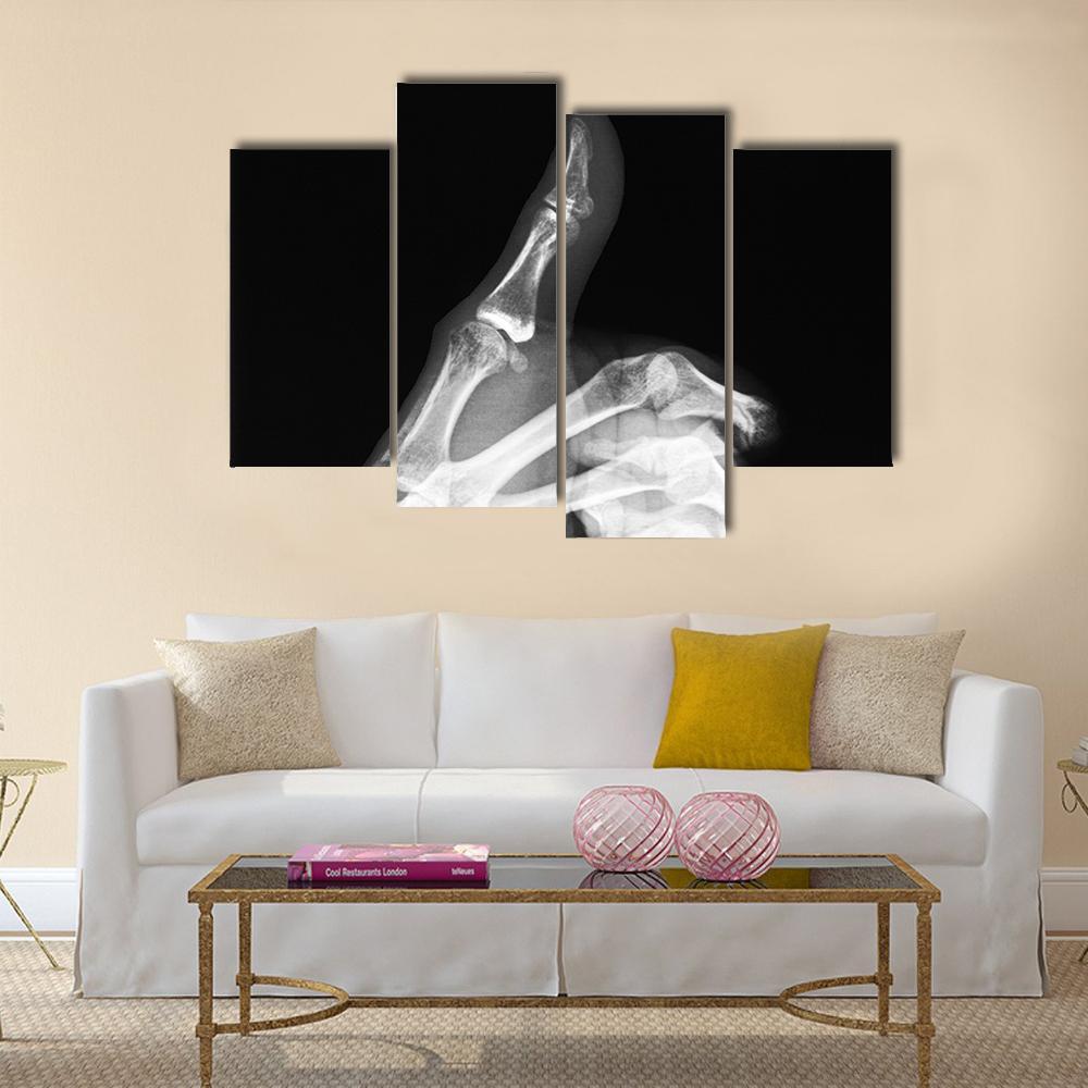 X-Ray Of Thumb Up Canvas Wall Art-4 Pop-Gallery Wrap-50" x 32"-Tiaracle