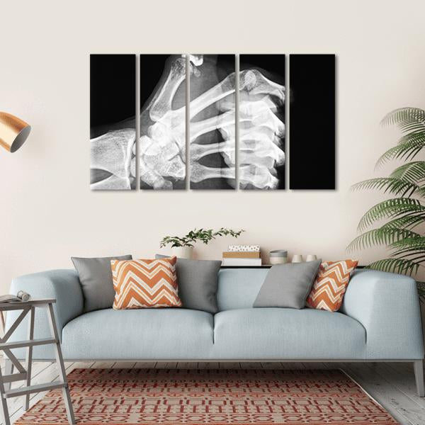 X-Ray Of Thumb Up Canvas Wall Art-5 Horizontal-Gallery Wrap-22" x 12"-Tiaracle
