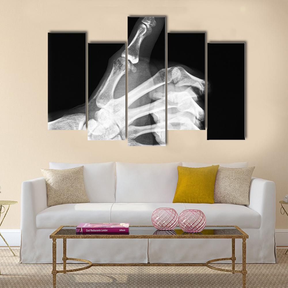X-Ray Of Thumb Up Canvas Wall Art-5 Pop-Gallery Wrap-47" x 32"-Tiaracle