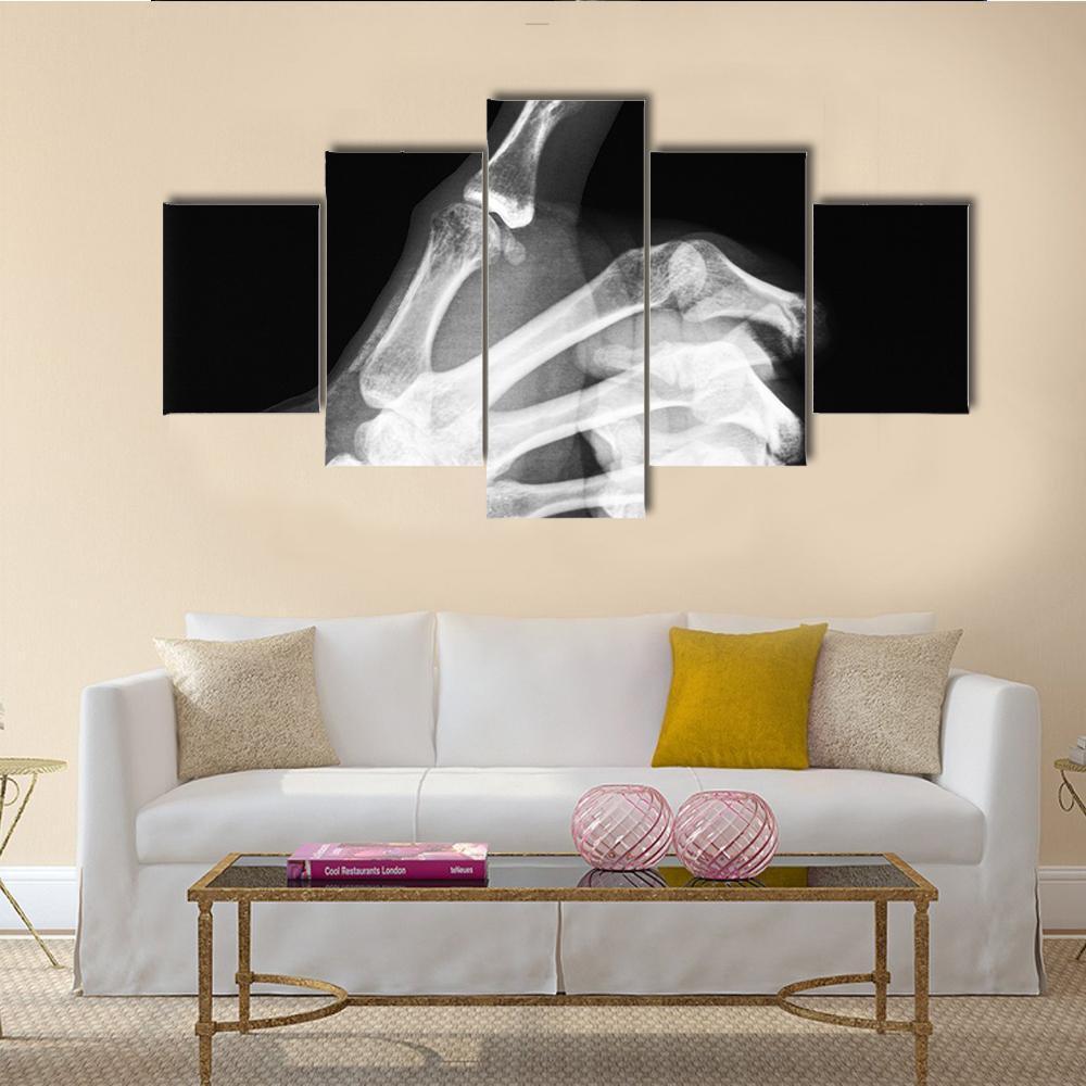 X-Ray Of Thumb Up Canvas Wall Art-5 Star-Gallery Wrap-62" x 32"-Tiaracle