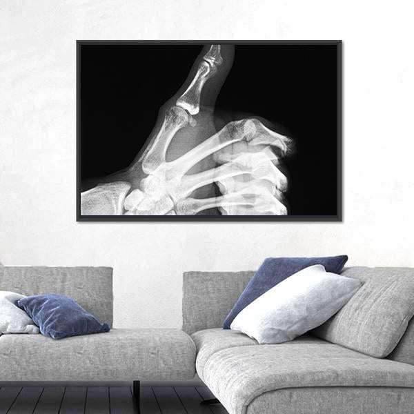 X-Ray Of Thumb Up Vertical Canvas Wall Art-3 Vertical-Gallery Wrap-12" x 25"-Tiaracle