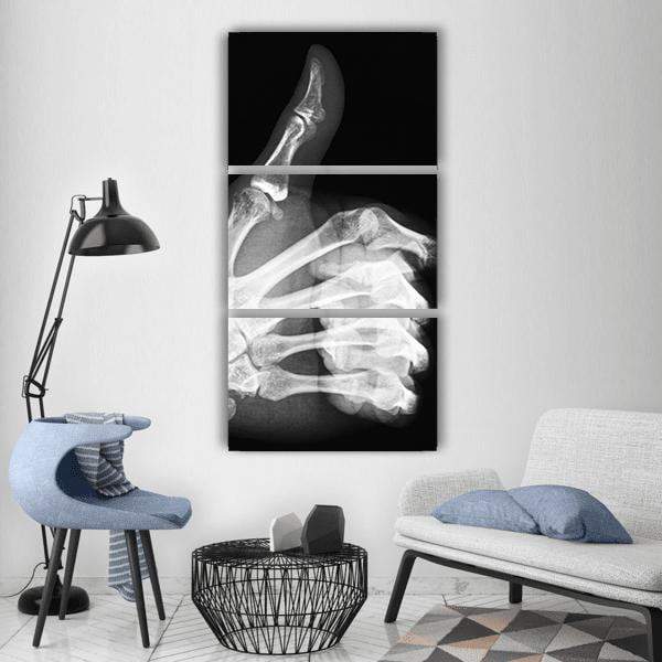 X-Ray Of Thumb Up Vertical Canvas Wall Art-3 Vertical-Gallery Wrap-12" x 25"-Tiaracle