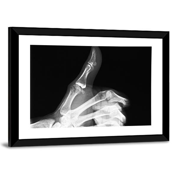 X-Ray Of Thumb Up Vertical Canvas Wall Art-3 Vertical-Gallery Wrap-12" x 25"-Tiaracle