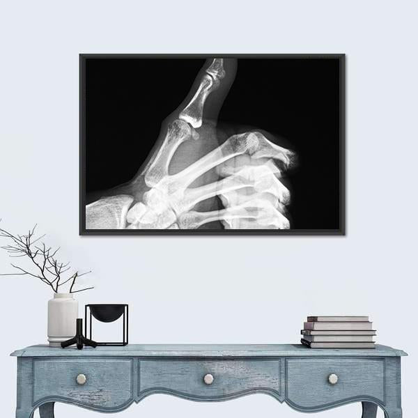 X-Ray Of Thumb Up Vertical Canvas Wall Art-3 Vertical-Gallery Wrap-12" x 25"-Tiaracle