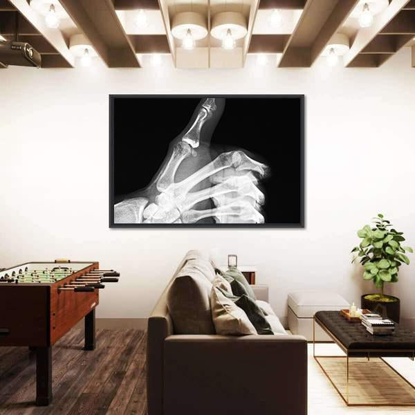 X-Ray Of Thumb Up Vertical Canvas Wall Art-3 Vertical-Gallery Wrap-12" x 25"-Tiaracle