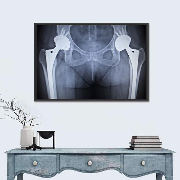 Bilateral Hip Prostheses X-ray Canvas Wall Art in black, white and blue, framed canvas, product view on a white background