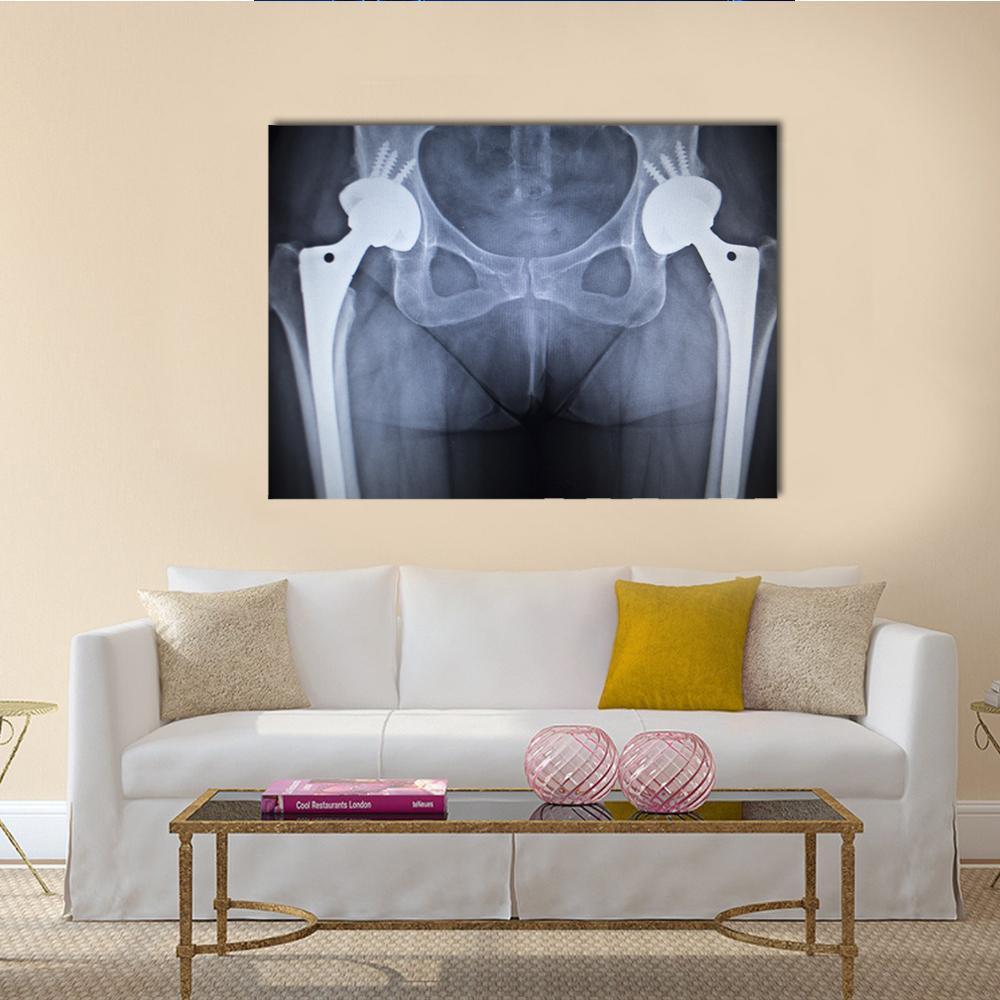 Hip Joint X-ray Scan Canvas Wall Art in black, white and blue, single panel hung on a wall