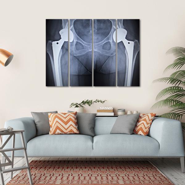 X-Ray Scan Image Of Hip Joints Canvas Wall Art-4 Horizontal-Gallery Wrap-34" x 24"-Tiaracle
