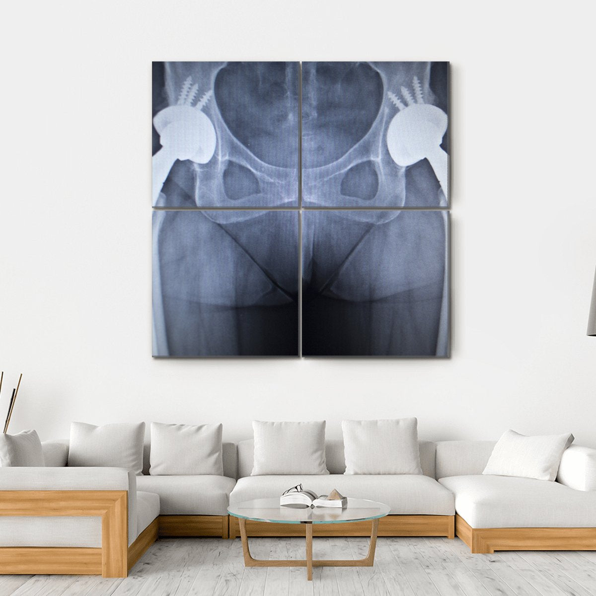 X-Ray Scan Image Of Hip Joints Canvas Wall Art-4 Square-Gallery Wrap-17" x 17"-Tiaracle