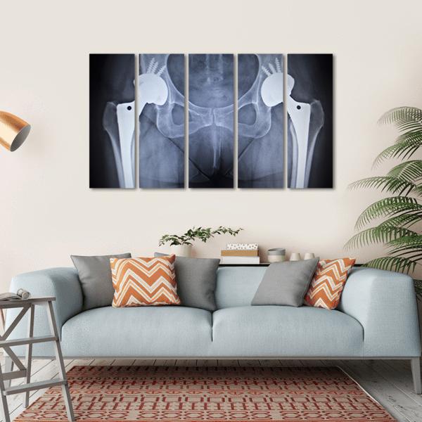 X-Ray Scan Image Of Hip Joints Canvas Wall Art-5 Horizontal-Gallery Wrap-22" x 12"-Tiaracle