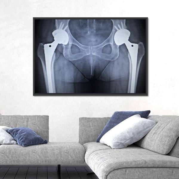 X-Ray Scan Image Of Hip Joints Canvas Wall Art-5 Horizontal-Gallery Wrap-22" x 12"-Tiaracle