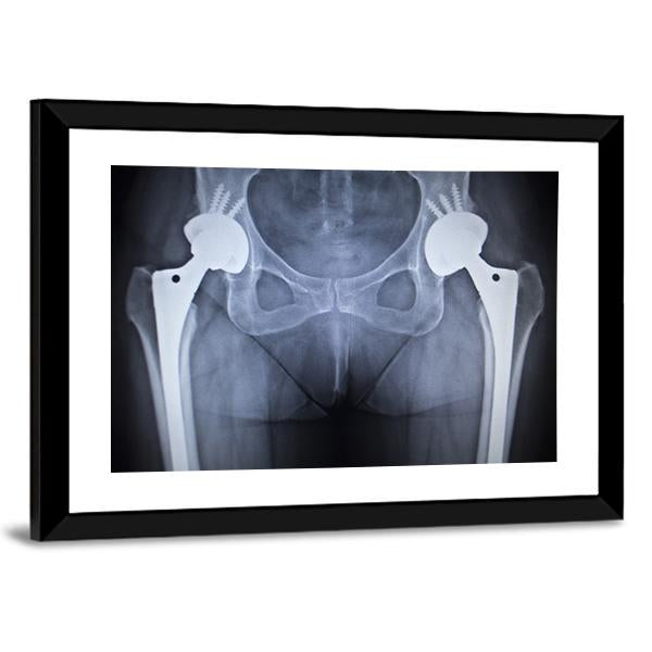 X-Ray Scan Image Of Hip Joints Canvas Wall Art-1 Piece-Framed Print-20" x 16"-Tiaracle