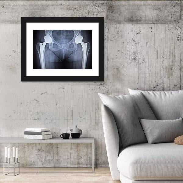 X-Ray Scan Image Of Hip Joints Canvas Wall Art-5 Horizontal-Gallery Wrap-22" x 12"-Tiaracle
