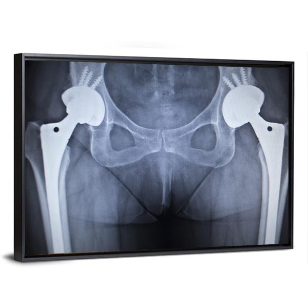 X-Ray Scan Image Of Hip Joints Canvas Wall Art-1 Piece-Floating Frame-24" x 16"-Tiaracle