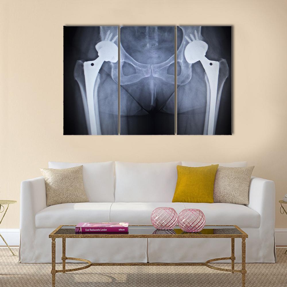 X-Ray Scan Image Of Hip Joints Canvas Wall Art-3 Horizontal-Gallery Wrap-37&quot; x 24&quot;-Tiaracle