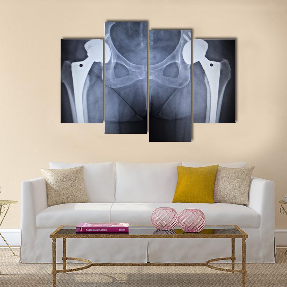 X-Ray Scan Image Of Hip Joints Canvas Wall Art-4 Pop-Gallery Wrap-50&quot; x 32&quot;-Tiaracle