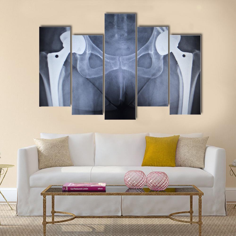 X-Ray Scan Image Of Hip Joints Canvas Wall Art-5 Pop-Gallery Wrap-47&quot; x 32&quot;-Tiaracle