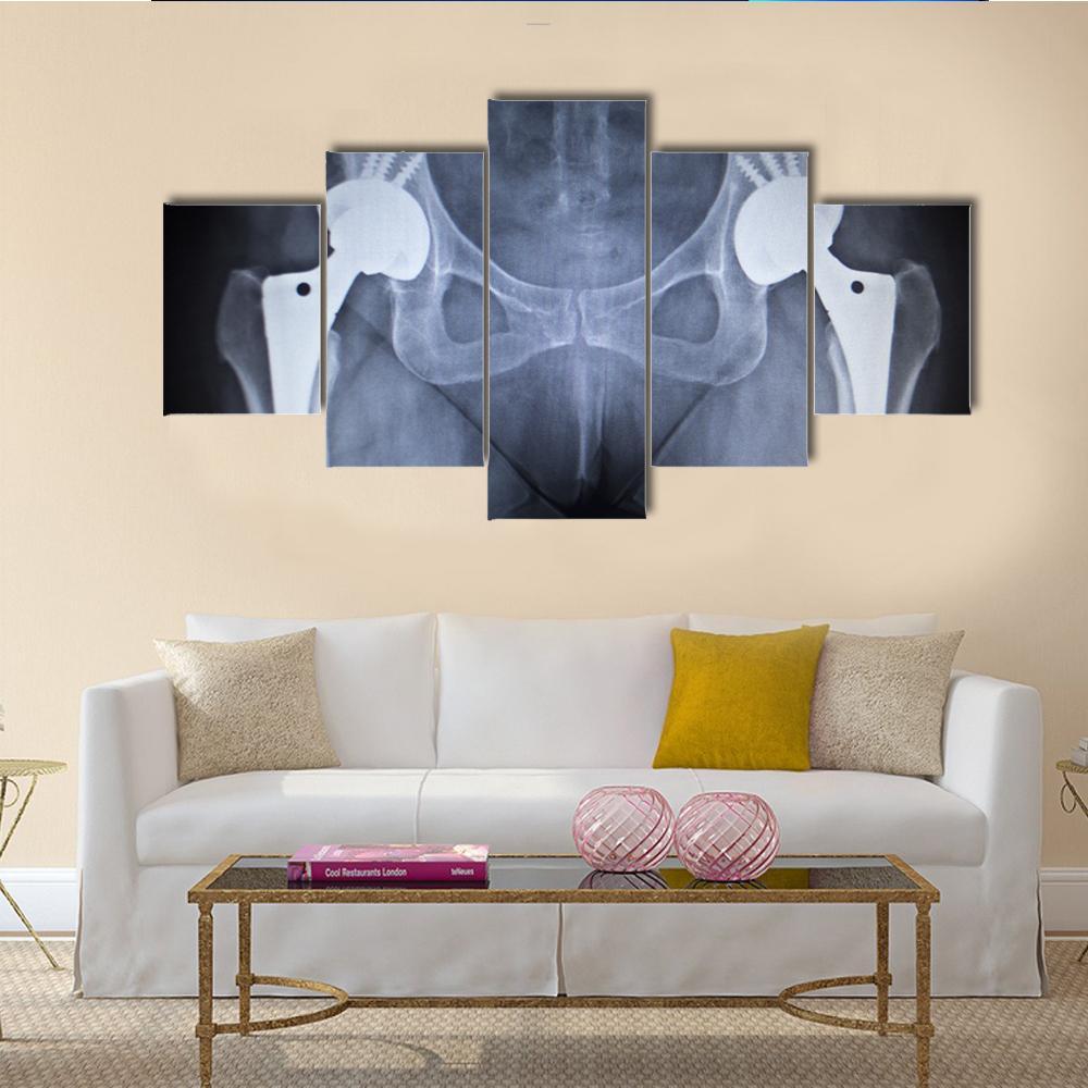 X-Ray Scan Image Of Hip Joints Canvas Wall Art-5 Star-Gallery Wrap-62" x 32"-Tiaracle